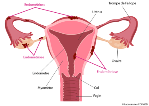 L' Endométriose